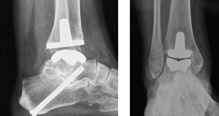 protesis para artrosis del tobillo