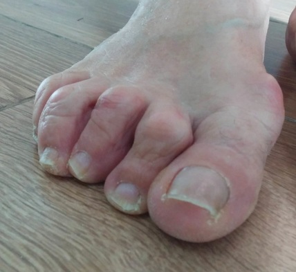 deformidad en los dedos del pie