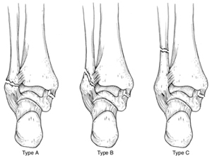 Tratamiento de las fracturas de tobillo. Una vez clasificada la fractura de tobillo se procede a realizar el mejor tratamiento para esta fractura. En general las fracturas poco desplazadas o las fracturas del peroné en la zona