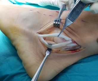 rotura de los tendones peroneos