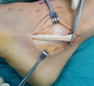 rotura de los tendones peroneos