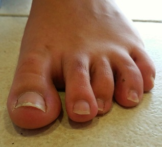  deformidad en los dedos del pie