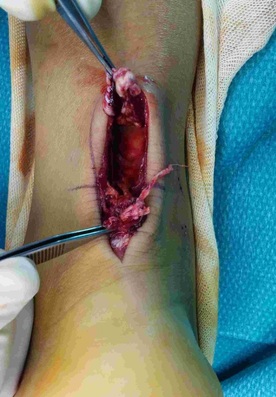 operacion del tendon de Aquiles