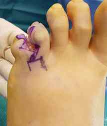  Tratamiento para la sindactilia del pie 