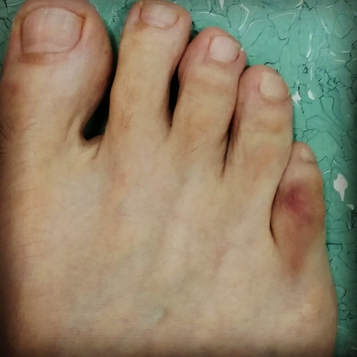 Tratamiento y recuperación de la fractura del dedo del pie
