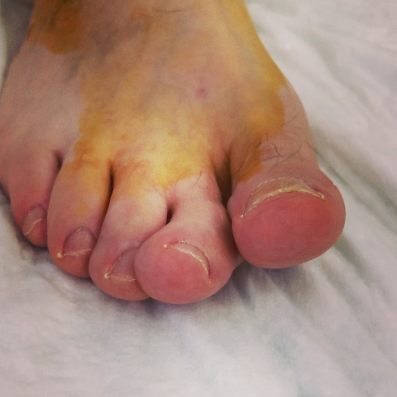 Tratamiento y recuperación de la fractura del dedo del pie