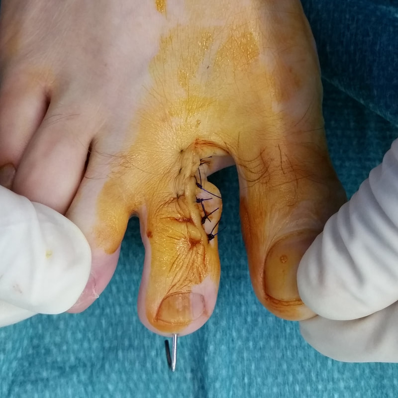 fractura del dedo del pie