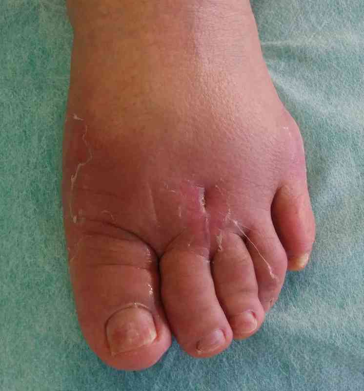Tratamiento de la rigidez de los dedos después de cirugía del pie.