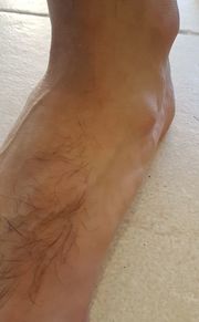 ganglión en el pie