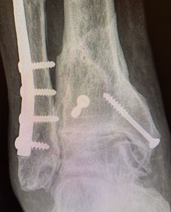ImagenPrótesis de tobillo para el tratamiento de la artrosis de tobillo