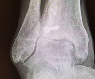 Prótesis de tobillo para el tratamiento de la artrosis de tobillo