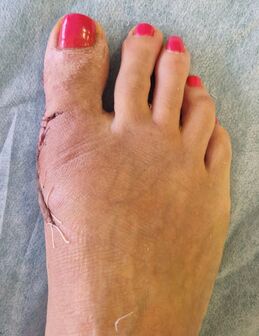 cirugia estetica del pie