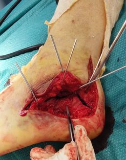 tratamiento quirúrgico de fractura de calcáneo