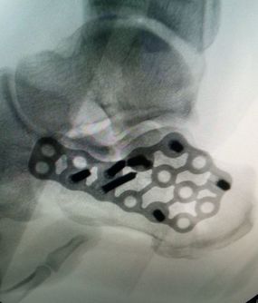 Tratamiento de fractura de calcáneo mediante placa lateral