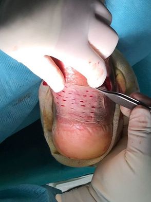 Tratamiento de la infección después de cirugía de  tendón de Aquiles