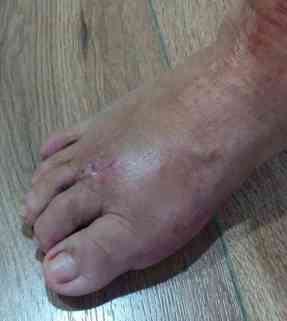 Tratamiento de la rigidez de los dedos después de cirugía del pie.