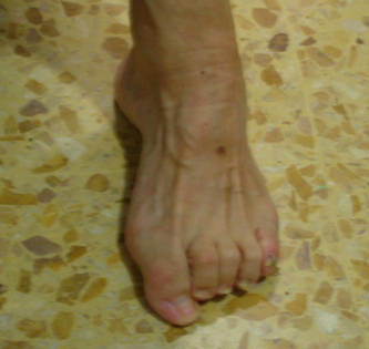 tratamiento en los pies con la enfermedad de Charcot Marie Tooth
