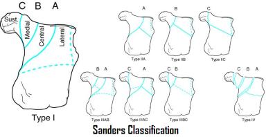 clasificacion de sanders de fractura de calcaneo